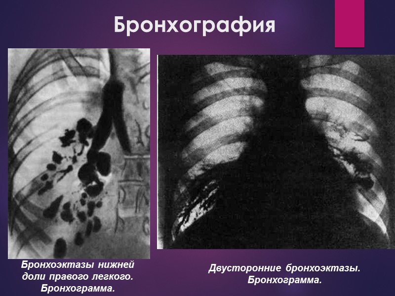 Бронхография Бронхоэктазы нижней доли правого легкого. Бронхограмма. Двусторонние бронхоэктазы. Бронхограмма.